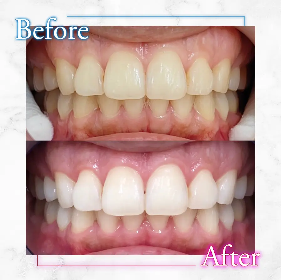 医療ホワイトニングの事例1