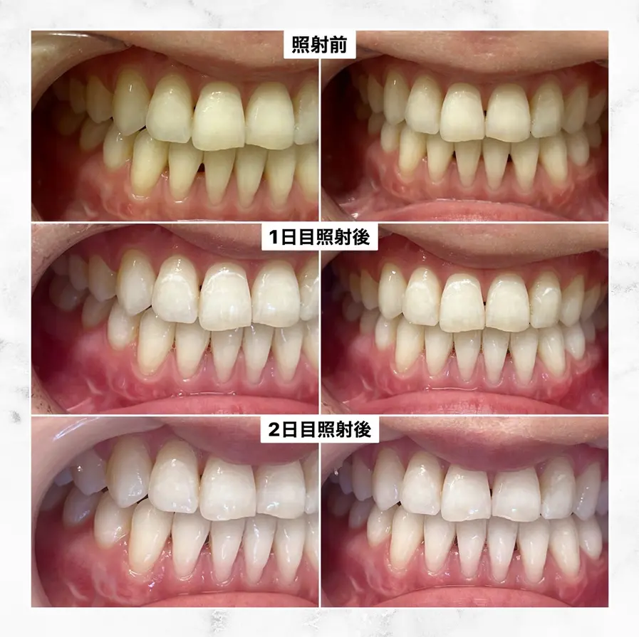 医療ホワイトニングの事例1